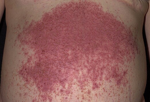 skin disorders pictures #10