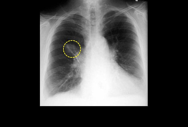 lobe pulmonary nodule