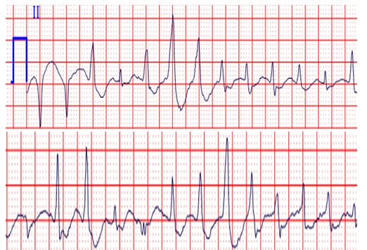 Subtle EKG Syndromes in Children and Adults