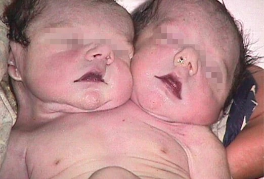 rare birth defect syndromes