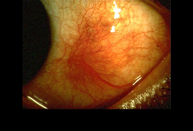 group test 2 eye Knowledge Your Vasculitis: Test