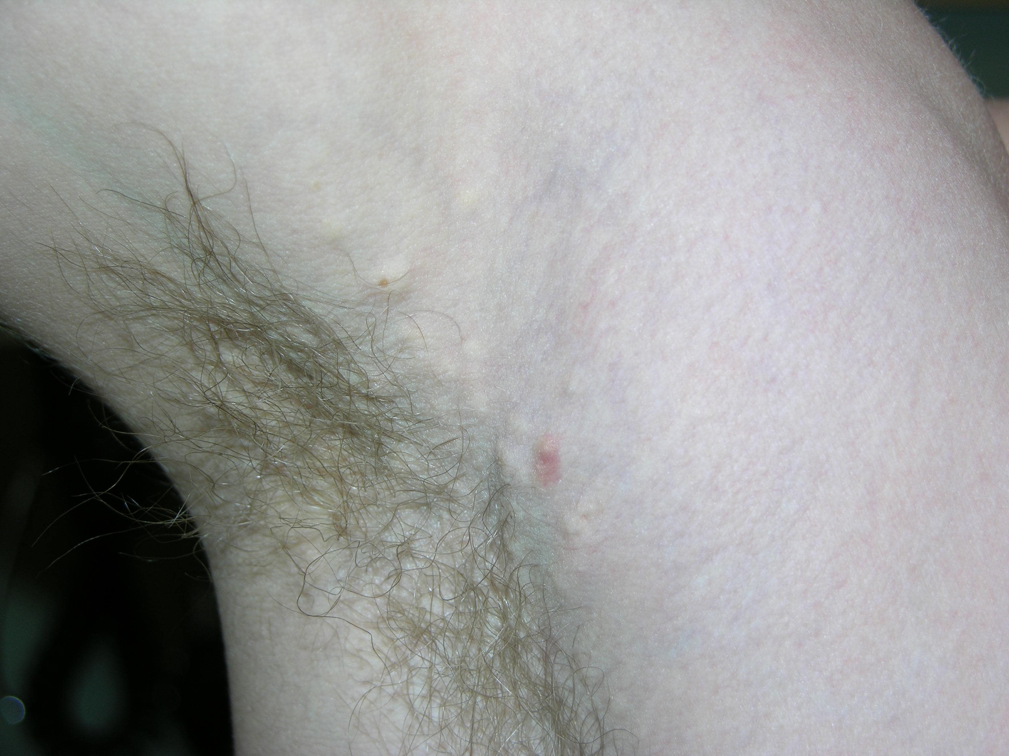 Eruptive Vellus Hair Cysts