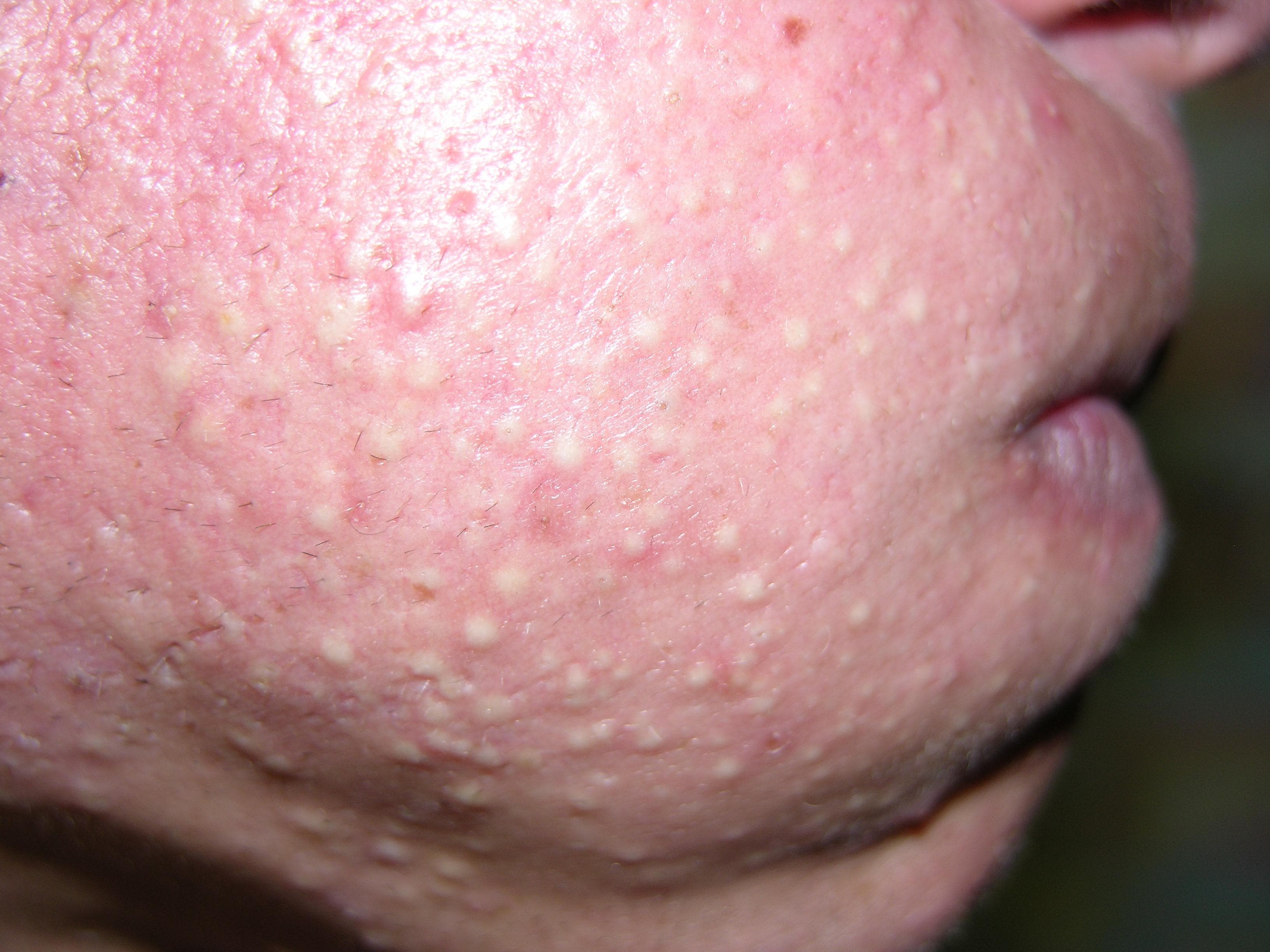 Eruptive Vellus Hair Cysts