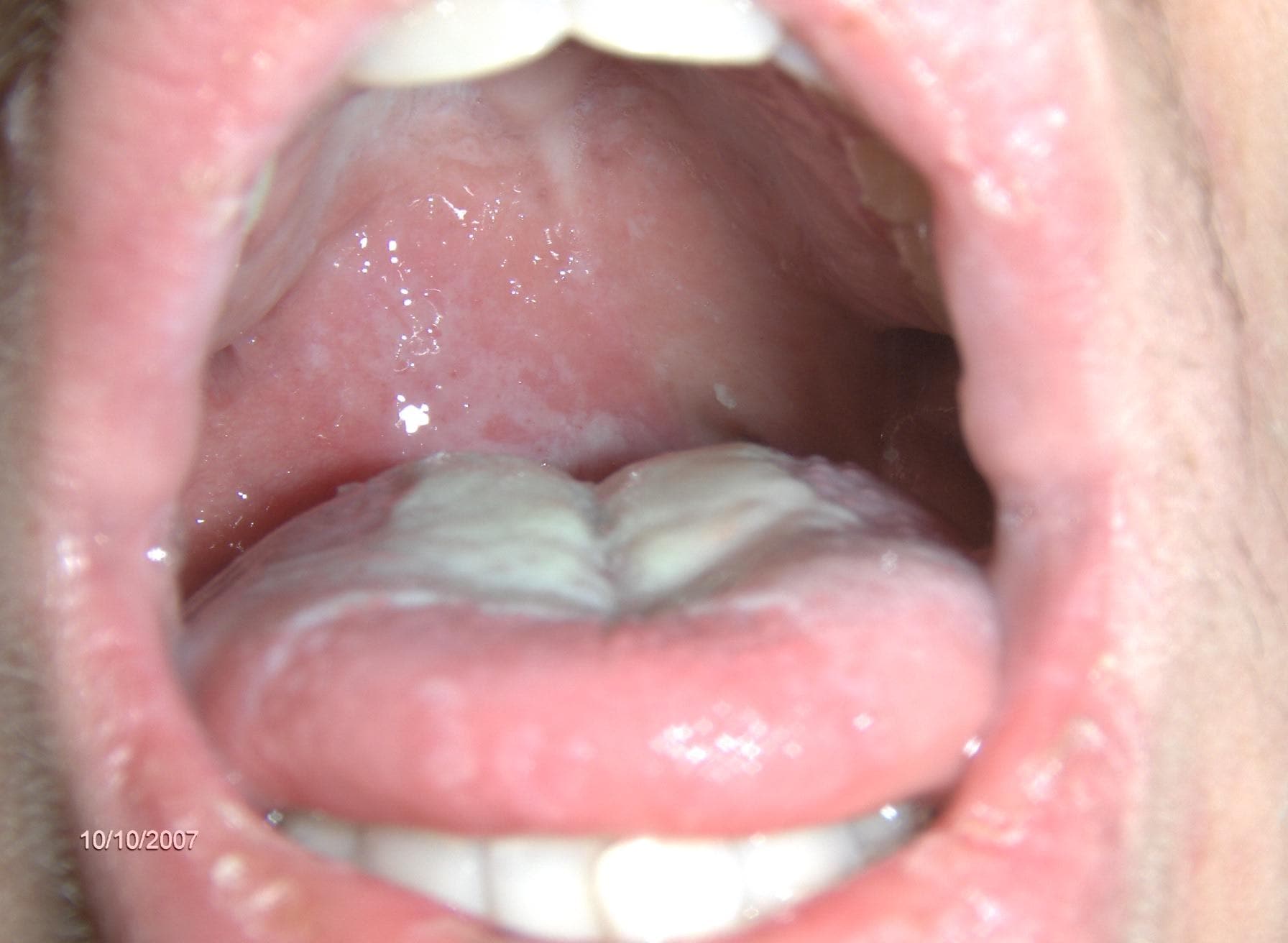 How to treat purulent quinsy in a child How to treat purulent quinsy in a child