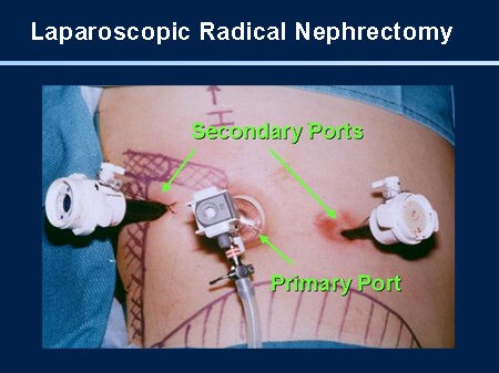 Initial Evaluation of Renal Cell Carcinoma and Surgical Management of ...