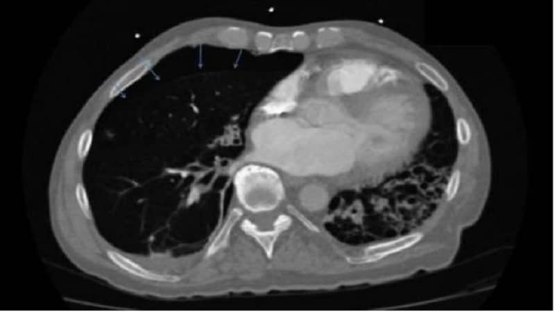 Sudden Onset Chest Pain In An 80 Year Old Man With COPD Page 6 sudden-onset-chest-pain-in-an-80-year-old-man-with-copd-page-6