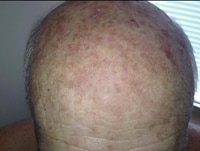 Actinic Keratosis: Diagnosis and Treatment Options