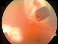 Hot Liquid Glass Injury As A Novel Mechanism For Intraocular Foreign Body Hot Liquid Glass Injury As A Novel Mechanism For Intraocular Foreign Body