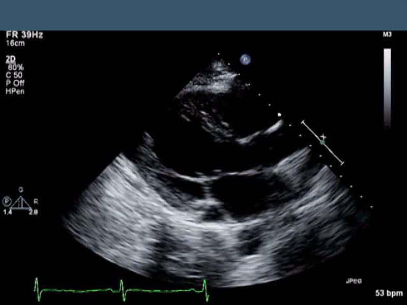 Dextrocardia or Reversed Limb Leads?