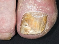 Diagnosis And Treatment Of Onychomycosis: Assess Your Skills