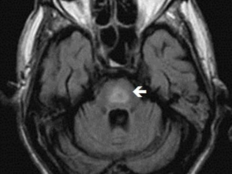 Hyponatremia in a 46-Year-Old Man After Head Trauma