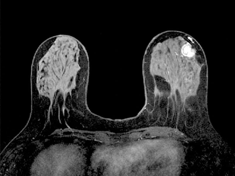 Optimizing MRI Breast Cancer Screening: A Multidisciplinary Perspective