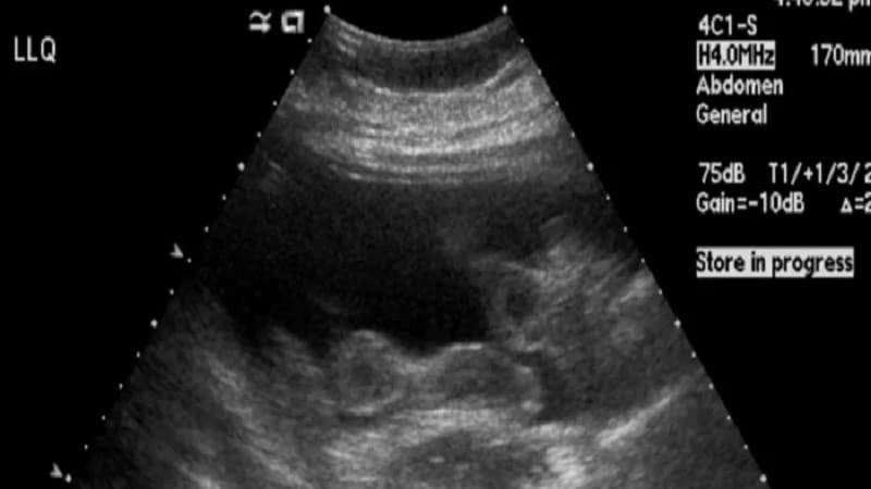 A 33-Year-Old Woman Trying to Conceive Has Dyspnea, Pain