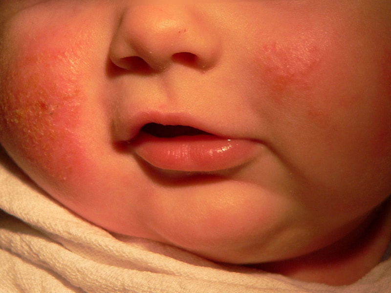 Are You Up to Date on Atopic Dermatitis?