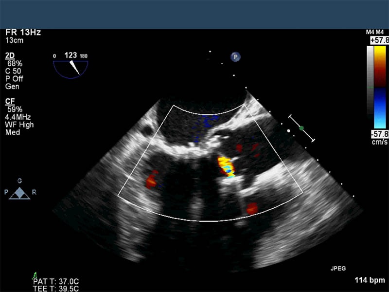 Analyze This Image Bioprosthetic Aortic Valve