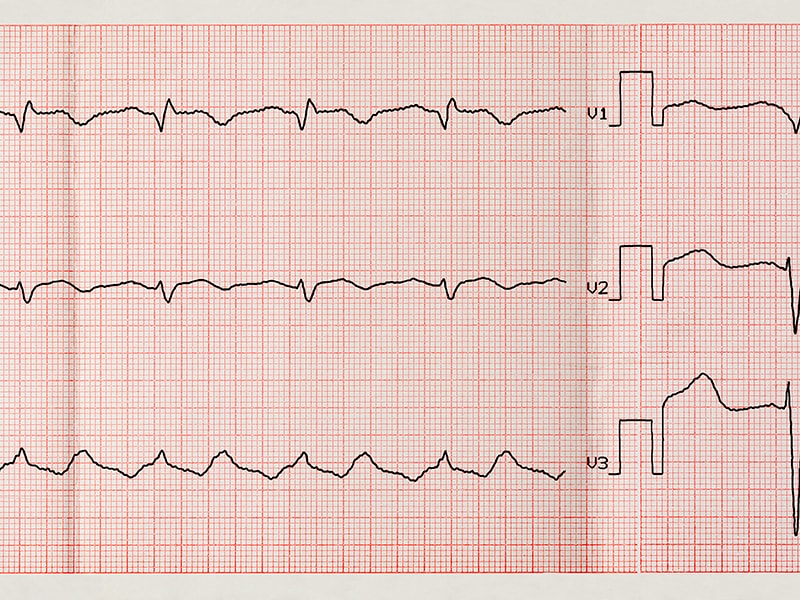 Atrial Flutter Life In The Fast Lane Ecg Library