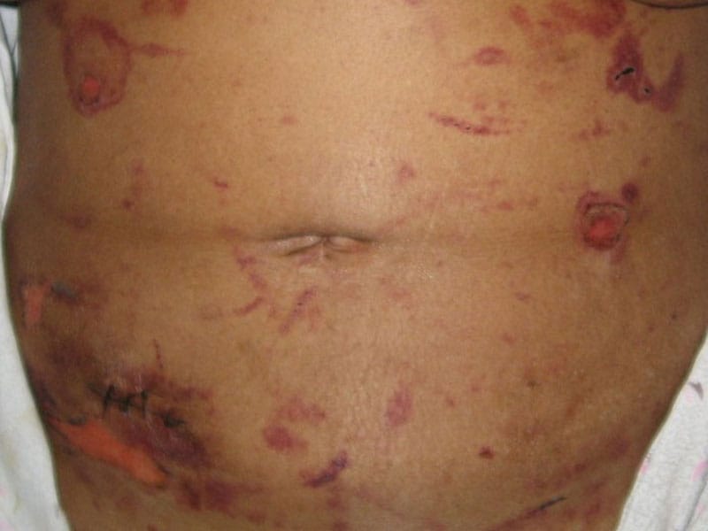 A 46-Year-Old Woman With Weakness and Leg Swelling