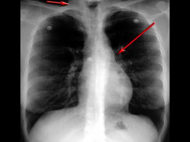 pulmonary veins xray