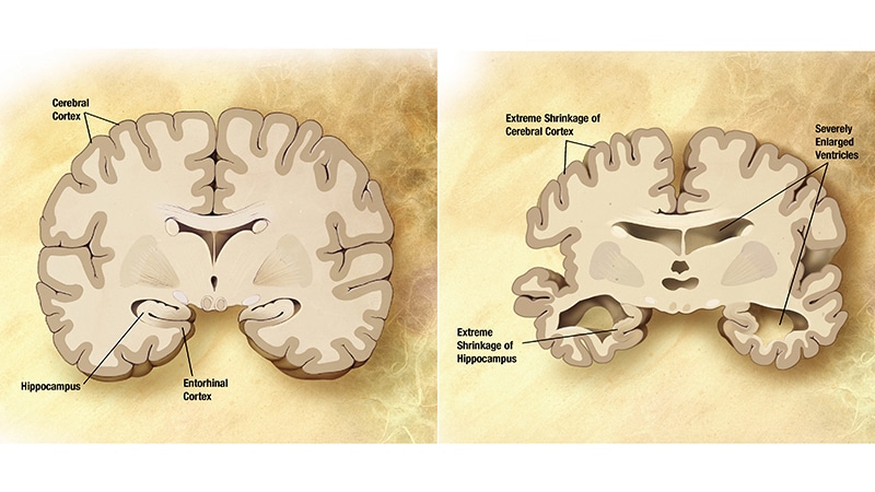 Fast Five Quiz: Key Aspects for Alzheimer's Disease - Page 5