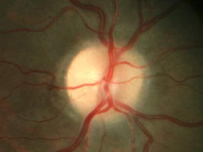 Seudotumor cerebral cerebri diamox Seudotumor cerebral cerebri diamox