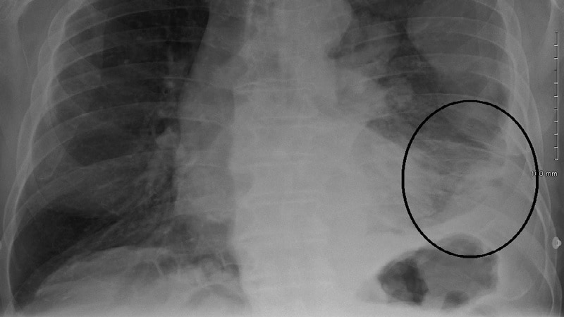 A 65 Year Old With Chest Pain And Fever Usmle Question