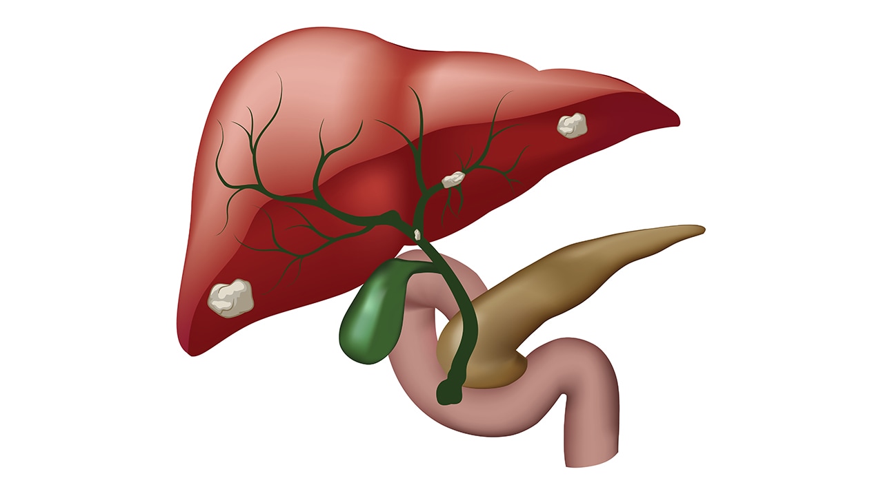 Targeted Therapies in Cholangiocarcinoma: How Much Do You Know?