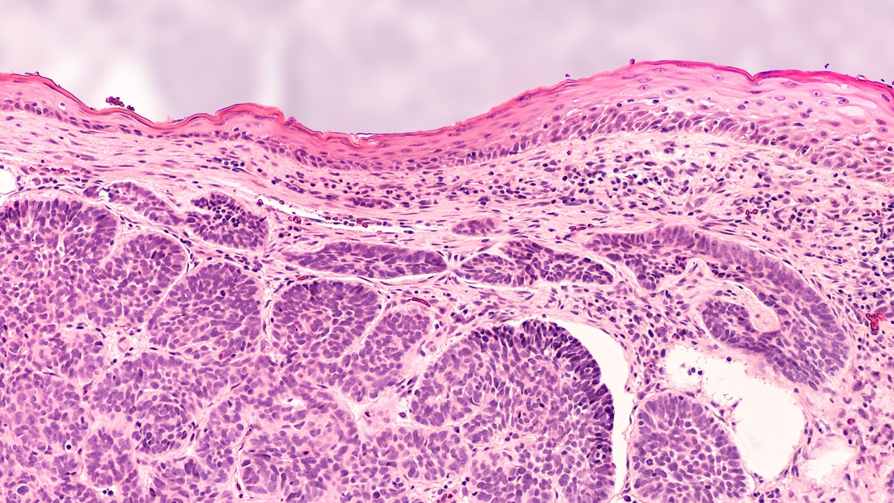 Insights on the Basal Cell Carcinoma Treatment Paradigm: Current ...