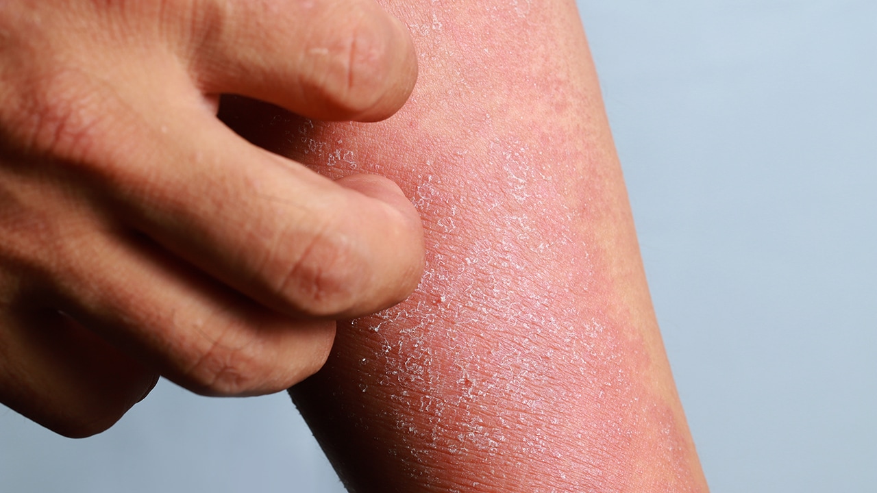 All You're Itching to Know About Atopic Dermatitis
