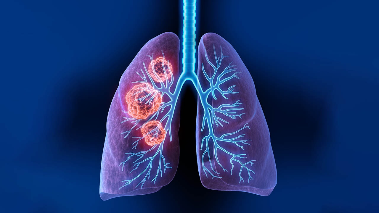 Best Practices in Diagnosing and Managing EGFR Exon 20 Insertion ...