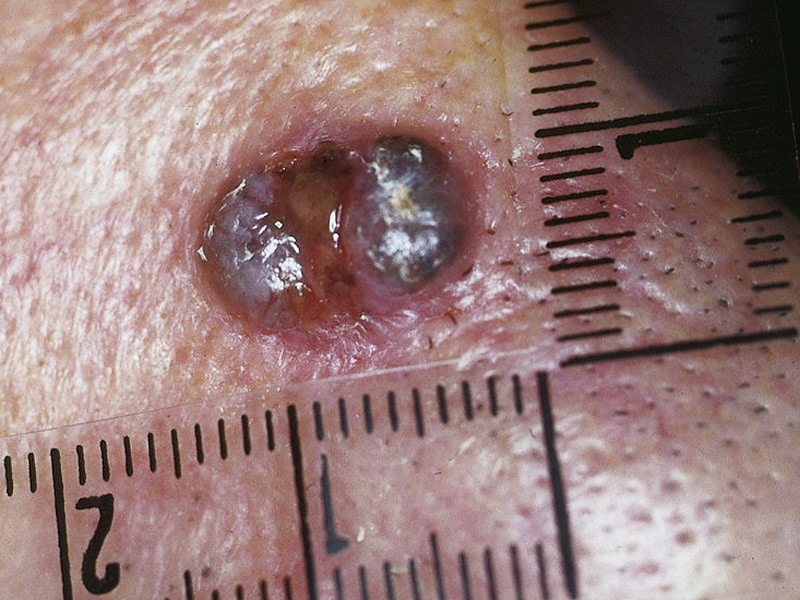 EMA Panel Likes Multiple Myeloma and Skin Cancer Drugs