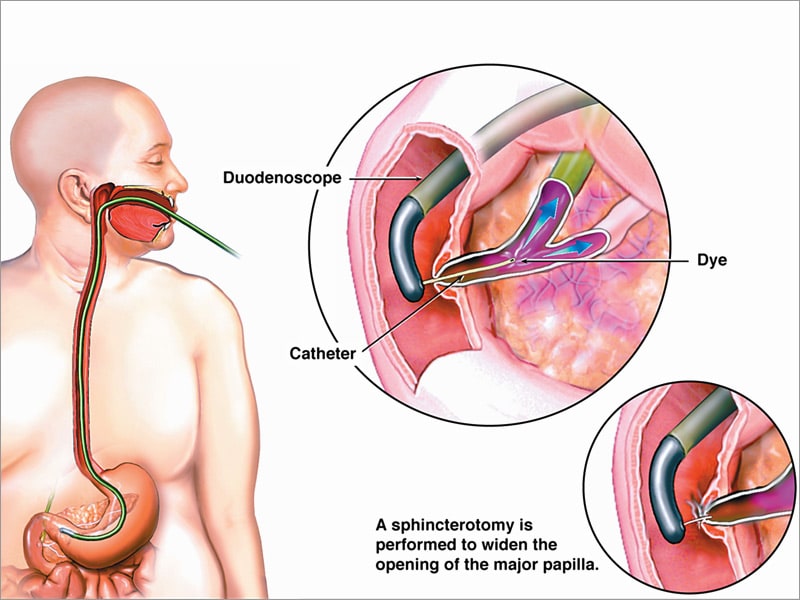 Duodenoscope Manufacturers Warned About Failure to Comply with Required Postmarket Surveillance Studies