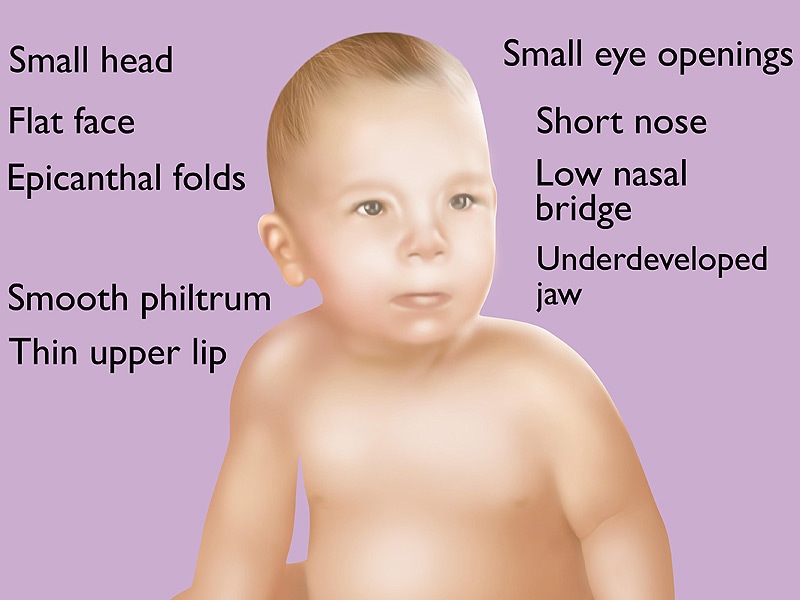 Fetal Alcohol Syndrome Photo