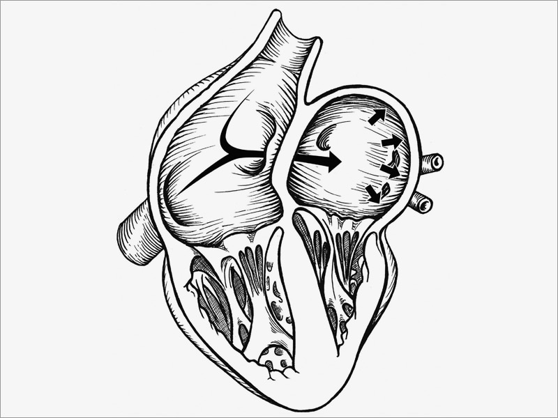 New AAN Guidance on Treating Stroke Patients With PFO