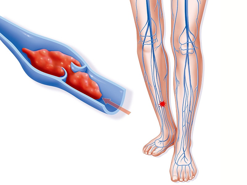 Real-World Reassurance on Bleeding Risk With DOACs in VTE