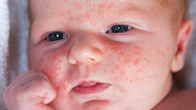 Neonatal Acne On Chest