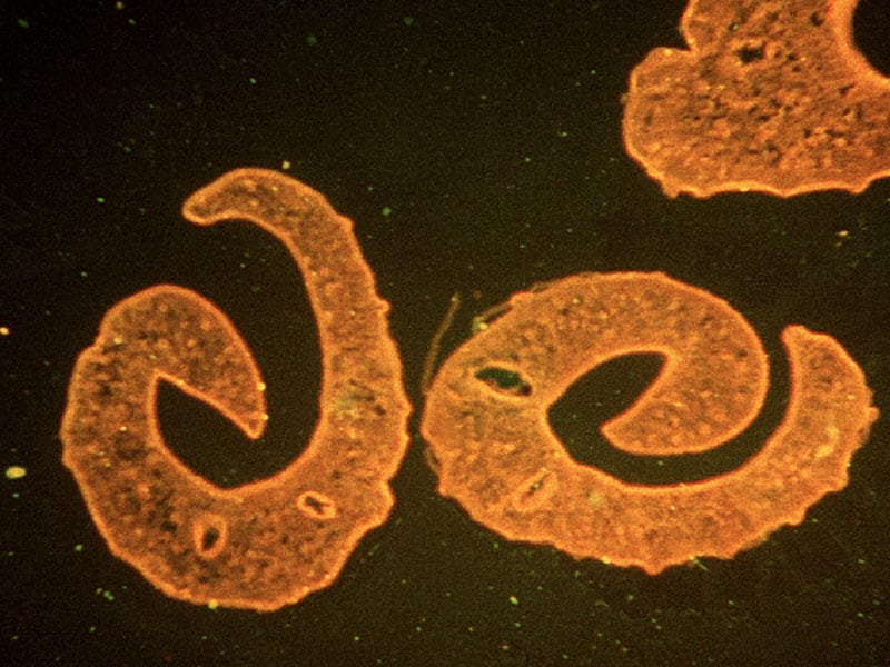 schistosomiasis medscape