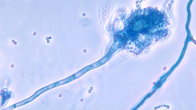 Fungal Cultures in Bronchiectasis Don’t Predict Outcomes