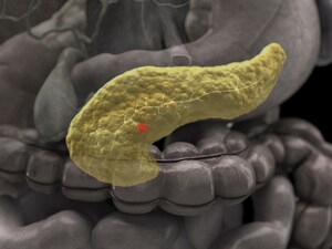 New Standard of Care in Metastatic Pancreatic Cancer?