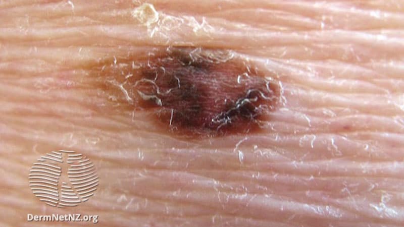 Incipient Ulceration May Affect Prognosis in Primary Melanoma