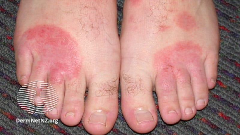 Deux produits biologiques évalués pour la dermatite du visage, des mains et des pieds