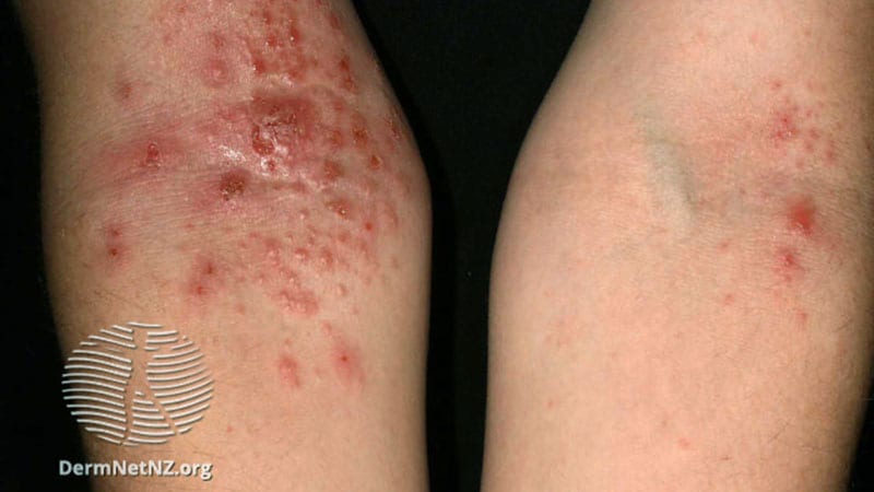 Les données montrent que les effets de la dermatite atopique du lebrikizumab sont maintenus