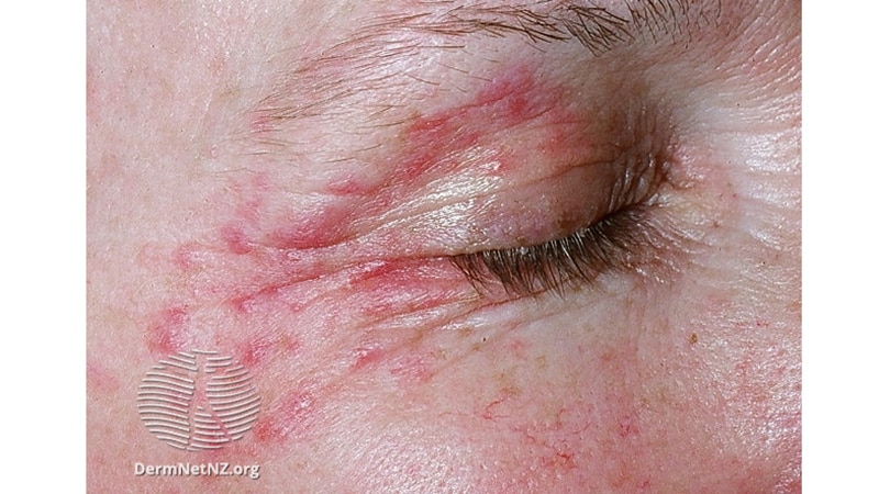 Les médicaments topiques pour les yeux sont une cause fréquente de dermatite de contact allergique