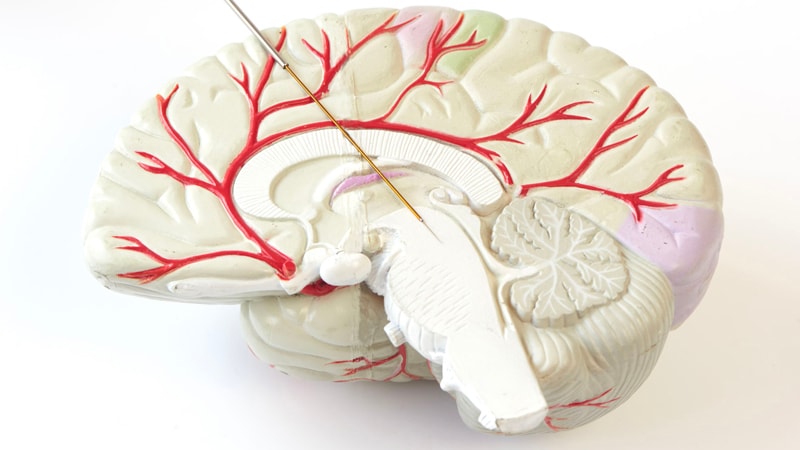La stimulation cérébrale peut améliorer le pronostic après un AVC