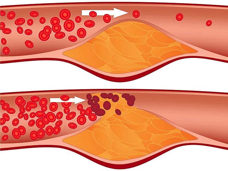 Predicting Plaque Rupture in CAD Review Lists Risky Signs