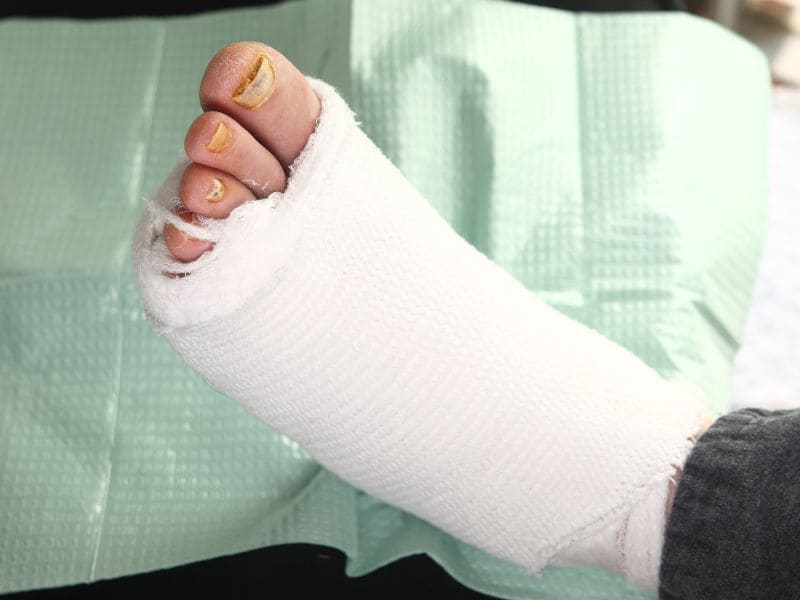 New Guidelines Stress Need for Diabetic Foot Ulcer Offloading