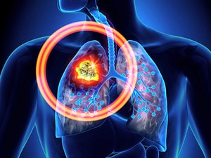 Pembrolizumab 1st-Line in NSCLC Also Boosts Quality of Life