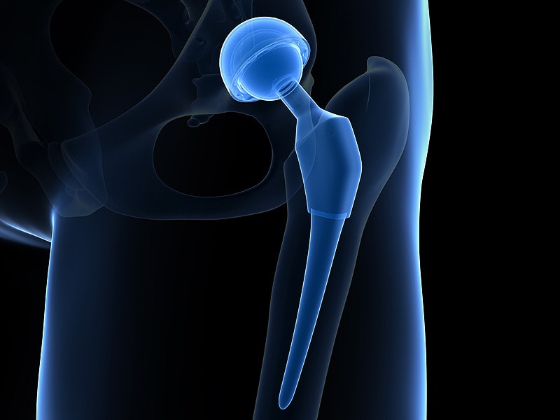 MoM Hip Implant Failure Linked to Manufacturing Variation