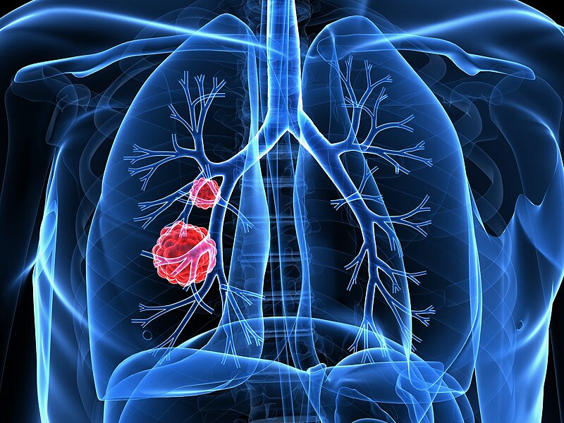 Lung Cancer Rates Surging in Never-Smokers