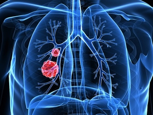 Lung Cancer Rates Surging in Never-Smokers