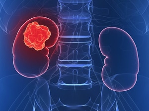 Active Surveillance for Metastatic Cancer? Just This One 
